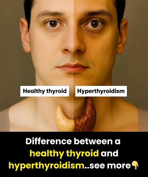 Difference between a healthy thyroid and hyperthyroidism