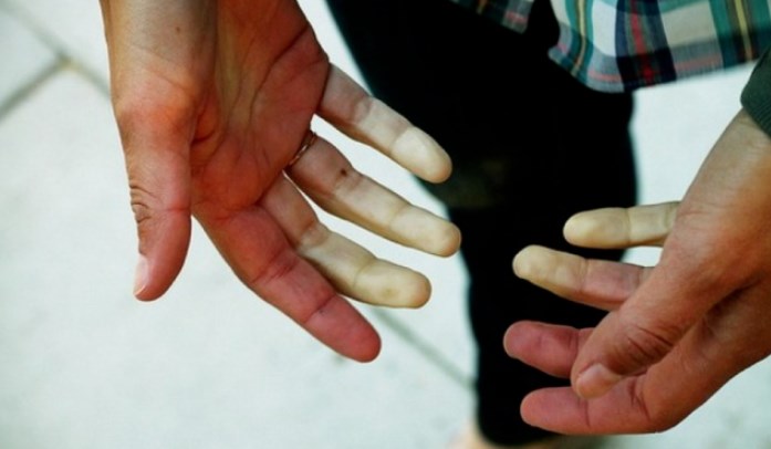 Nëse ju rrinë duart e ftohta? Kujdes, Zbuloni problemet që mund ta shkaktojnë