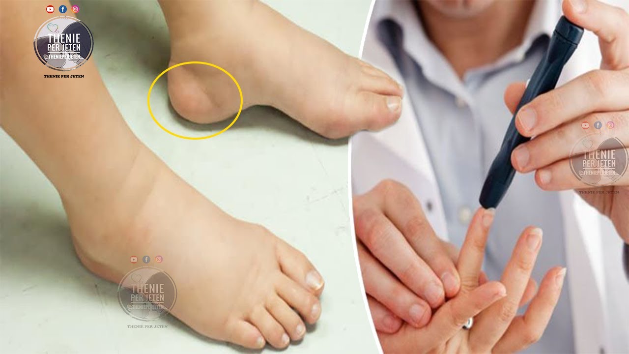 Nëse trupi ju jep këto 8 shenja, shkoni menjehere tek mjeku, po vuani nga diabeti