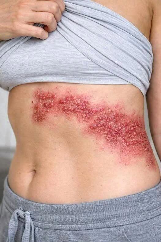 Why Acne Appears on These 8 Body Areas, and What You Should Do
