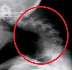 Young man hospitalized because he dropped his ca!