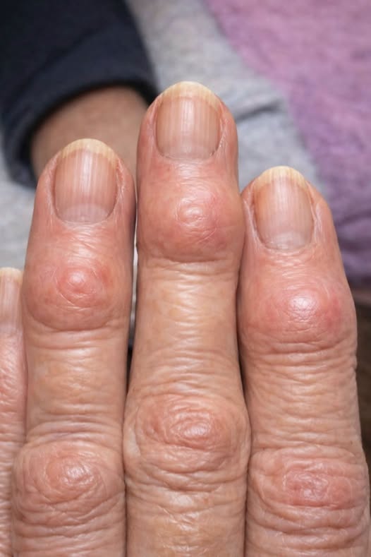 The Terrifying Truth Behind the Mysterious Hard Bumps Spreading Across Your Hands
