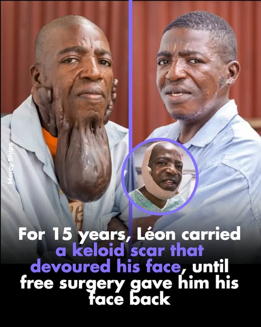 Léon carried a keloid scar for 15 years that devoured his face, until free surgery gave him back his face and his life