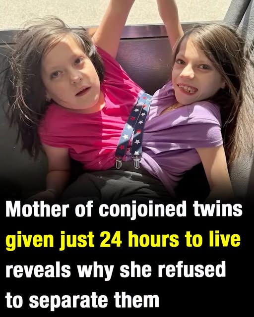 Mother of conjoined twins given just 24 hours to live reveals why she refused to separate them