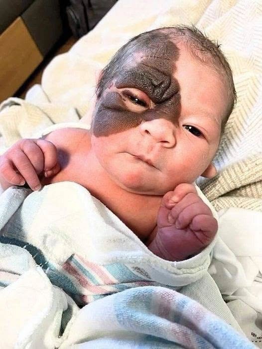 Mom wants to show 13 month old daughter with rare birthmark that she is beautiful