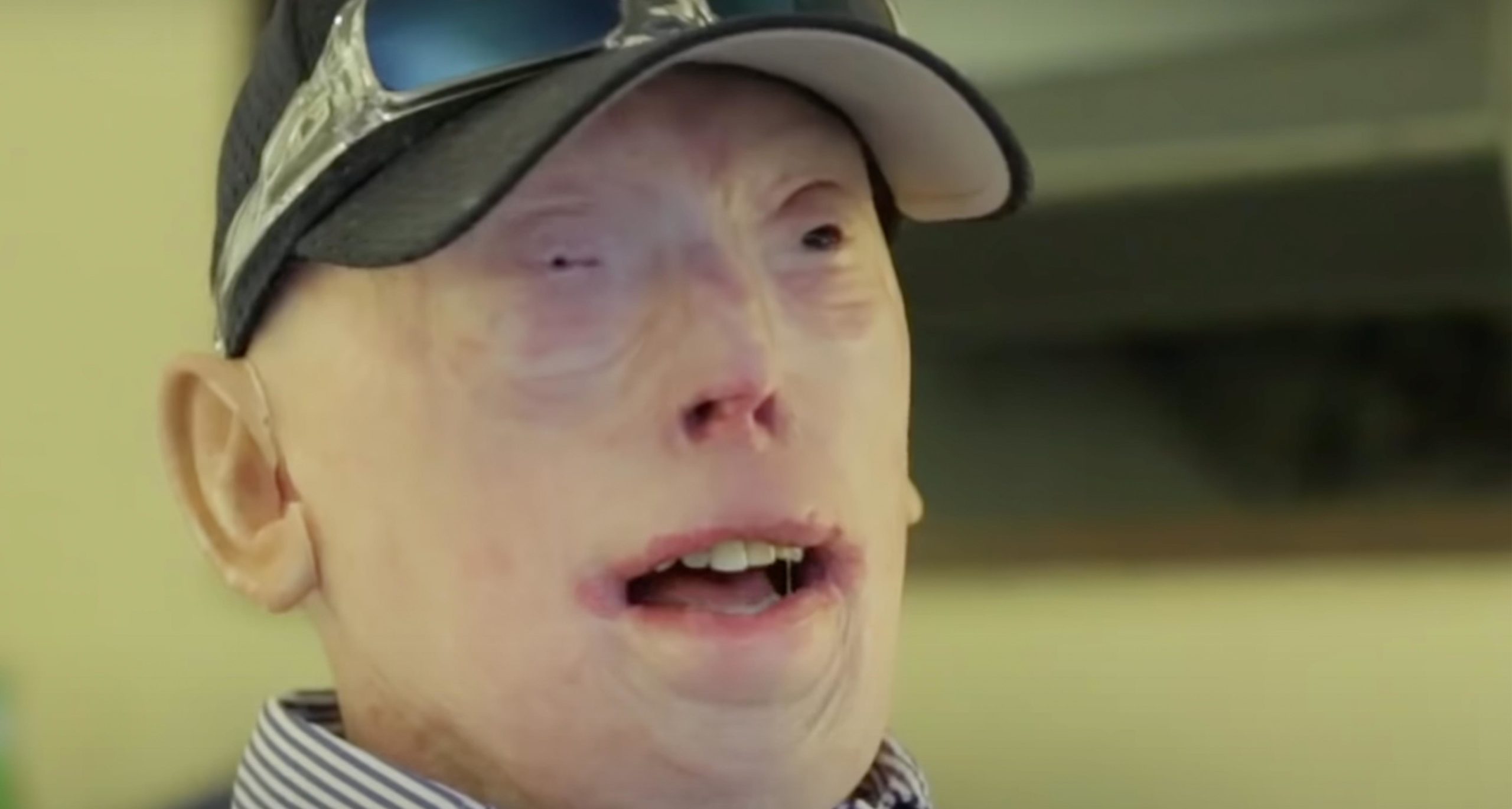 Patrick Hardison received a new face after third-degree burns, this is him today